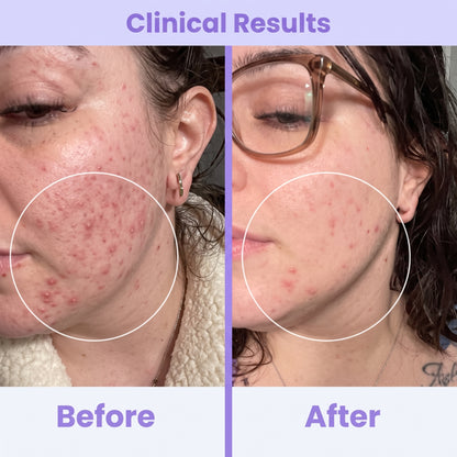 Clinical High Frequency Wand