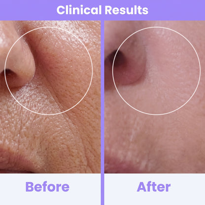 Clinical High Frequency Wand