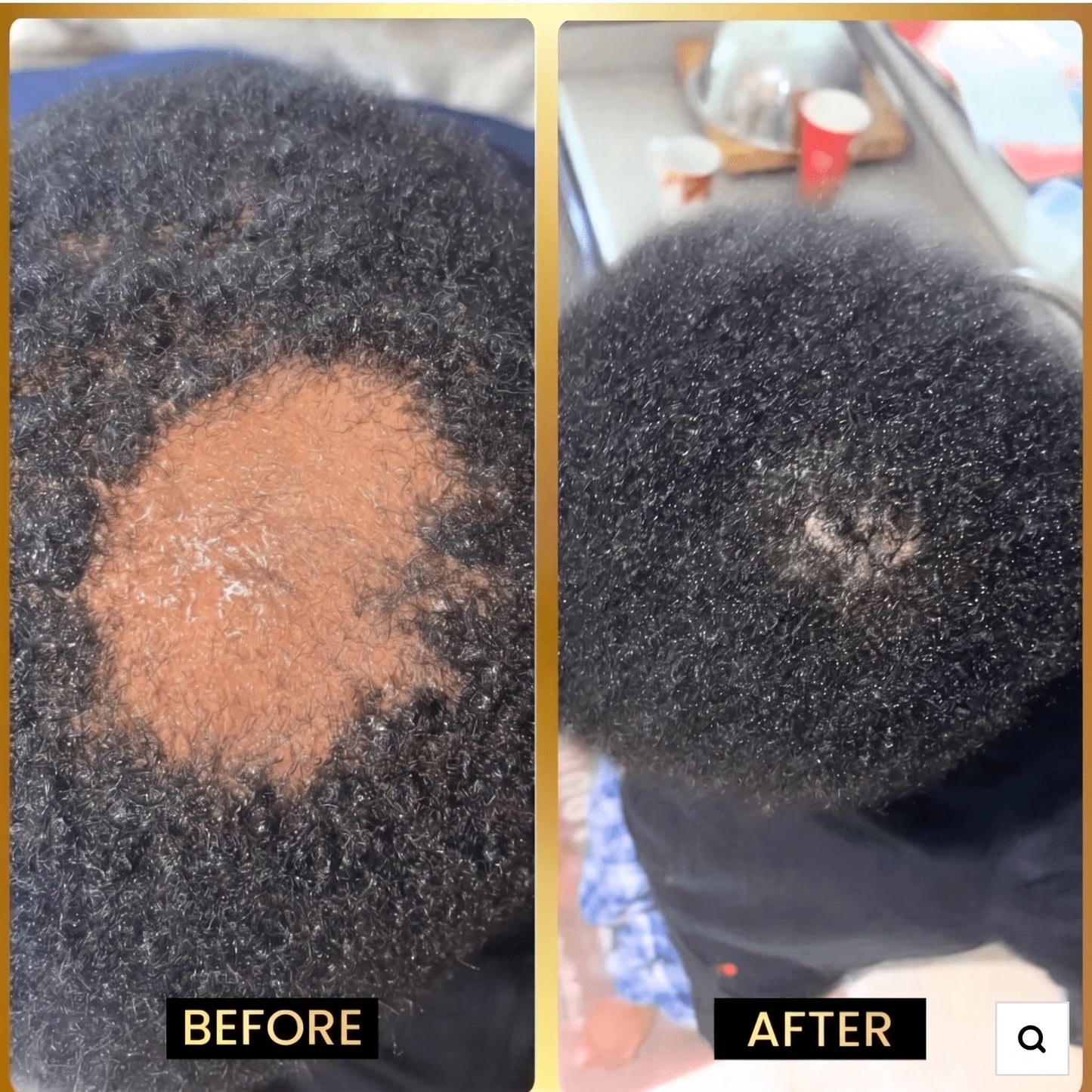 Scalp Stimulator hair growth oil