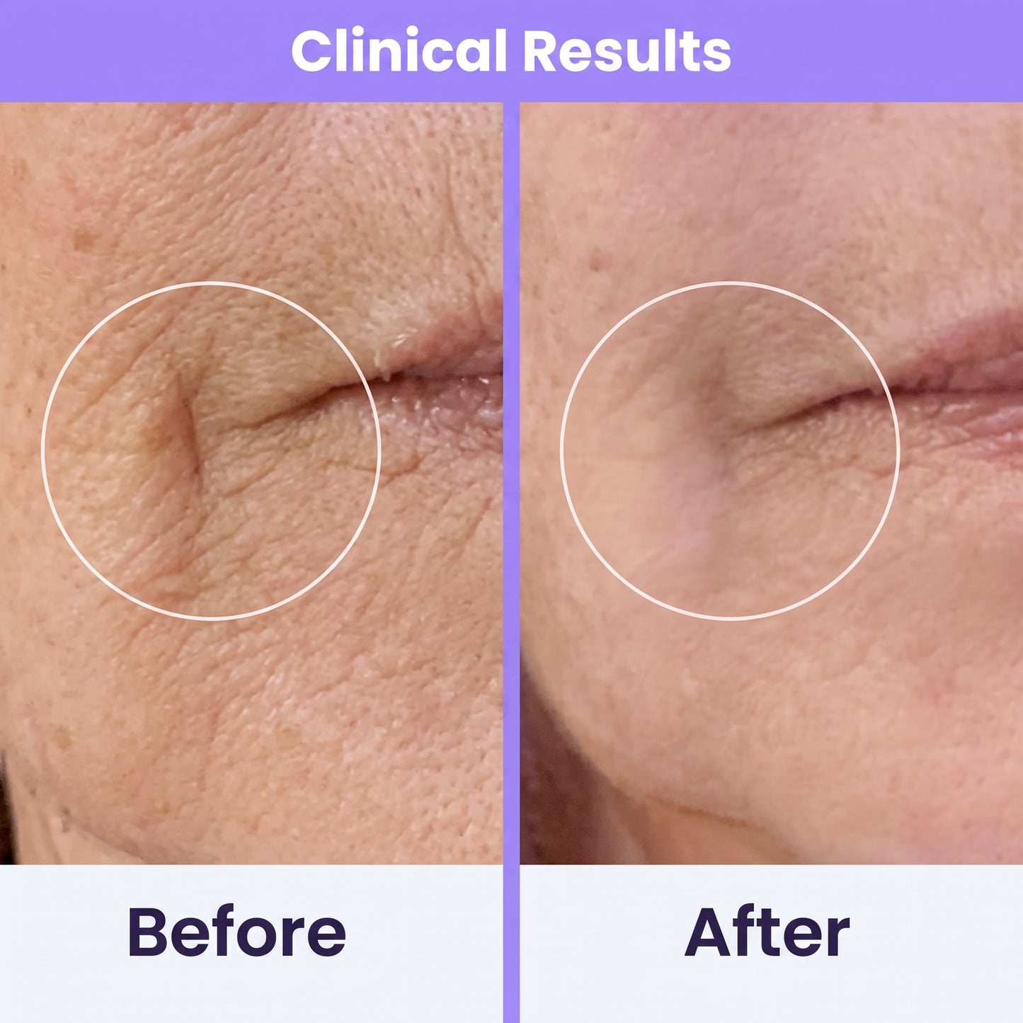 Clinical High Frequency Wand