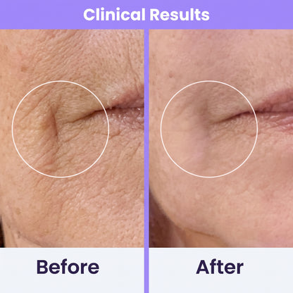 Clinical High Frequency Wand